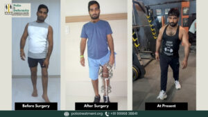 How A Poliotic Patient Got A New Life- Shiv Kishore’s Inspiring Story Of Recovery From Polio Deformity