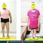 A New Lease of Life: Suman’s Polio Recovery Journey at Bhola Hospital, Kurukshetra (Polio & Deformity Correction Centre)