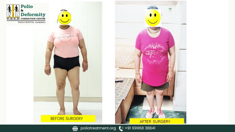 A New Lease of Life: Suman’s Polio Recovery Journey at Bhola Hospital, Kurukshetra (Polio & Deformity Correction Centre)