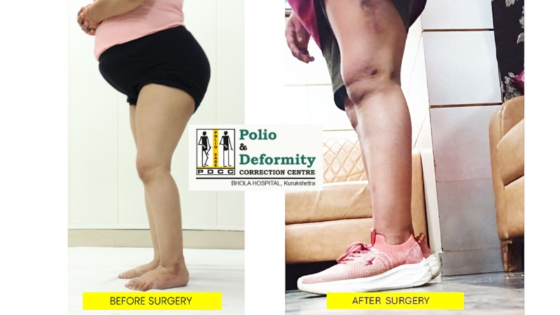 Suman’s Polio Recovery Journey